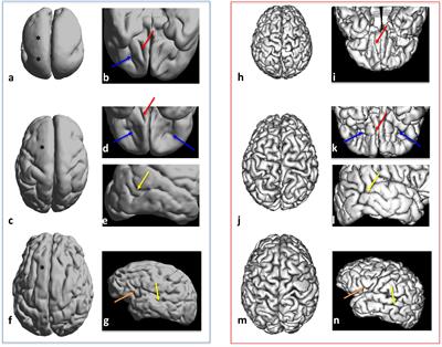 Structural and Diffusion MRI Analyses With Histological Observations in Patients With Lissencephaly